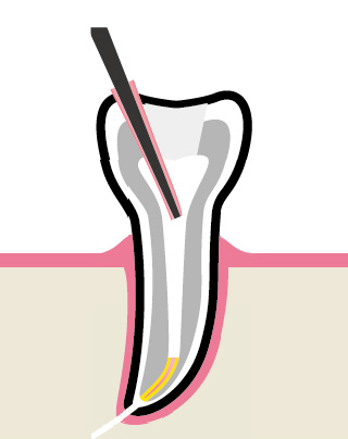 Вертикальная конденсация - этап 4 удаления излишков